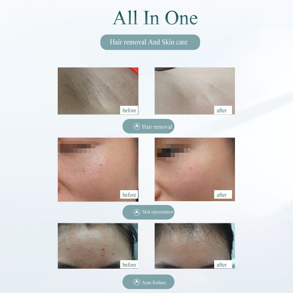 Laser Hair Removal Device - Painless Hair Removal Tool